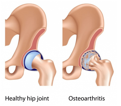 Hip Arthritis and test